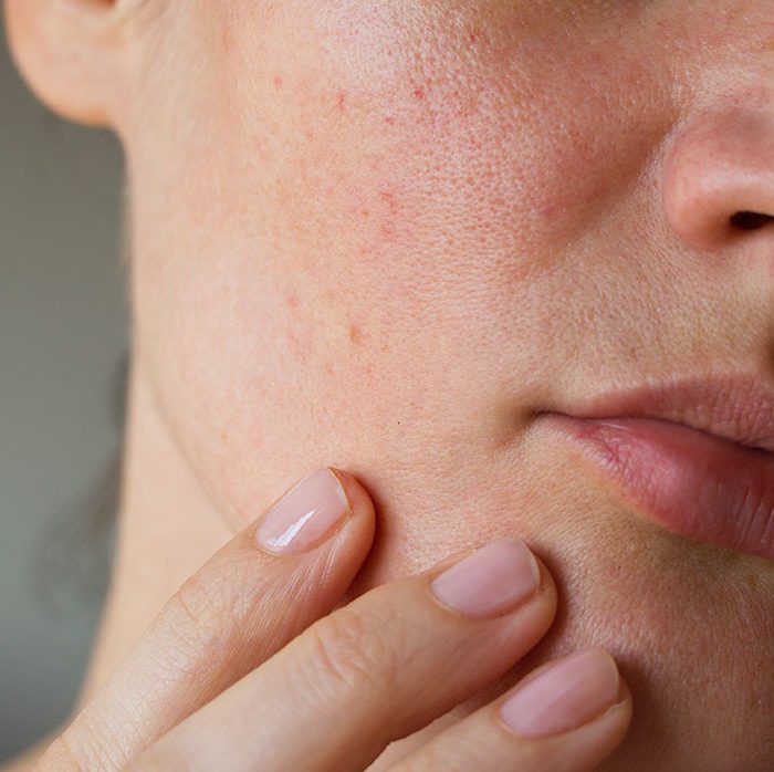 Alt du må vite om tørr og sensitiv hud