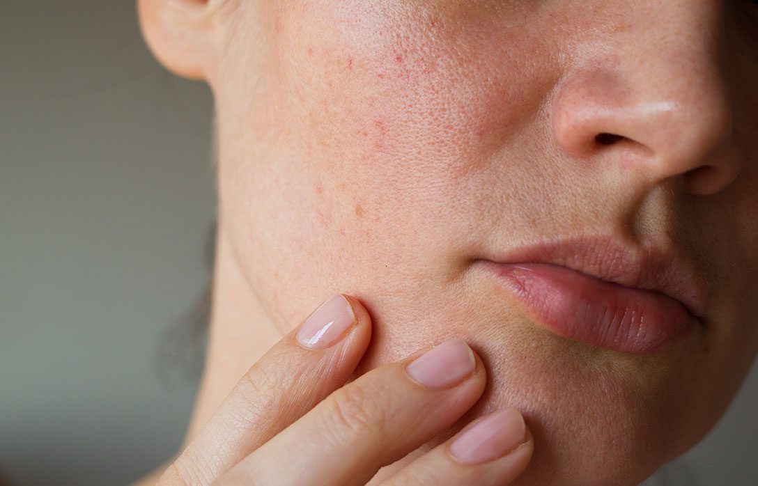 Alt du må vite om tørr og sensitiv hud
